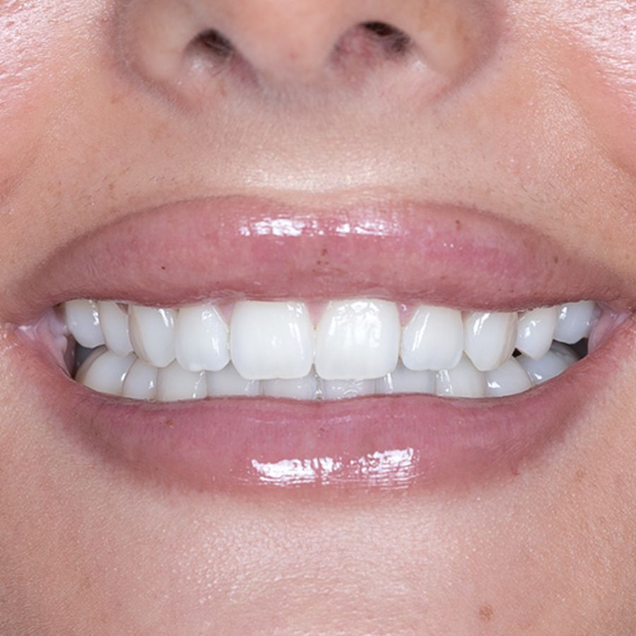 composite bonding-before-robyn-mcdonnell